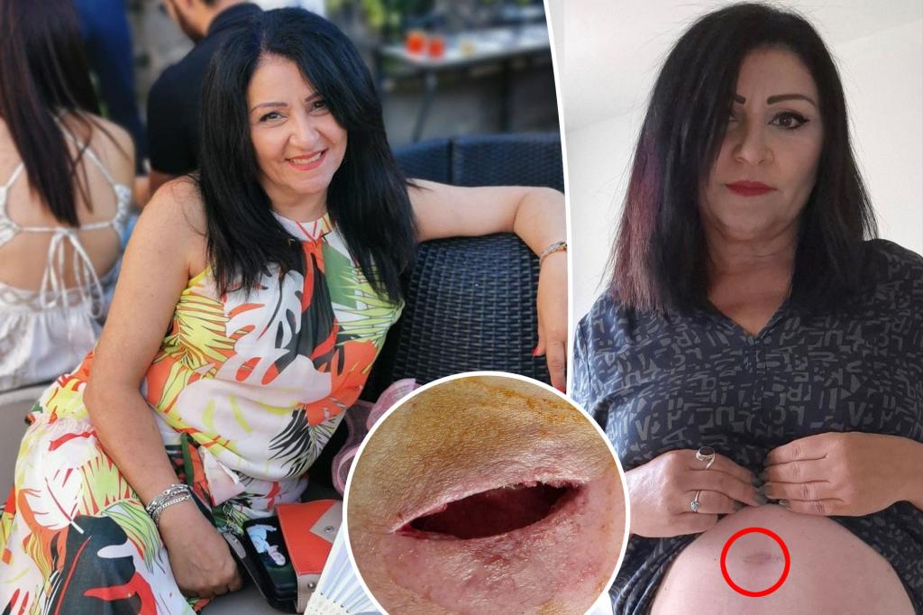 Fat melting injections leave the mother with an open wound on her stomach